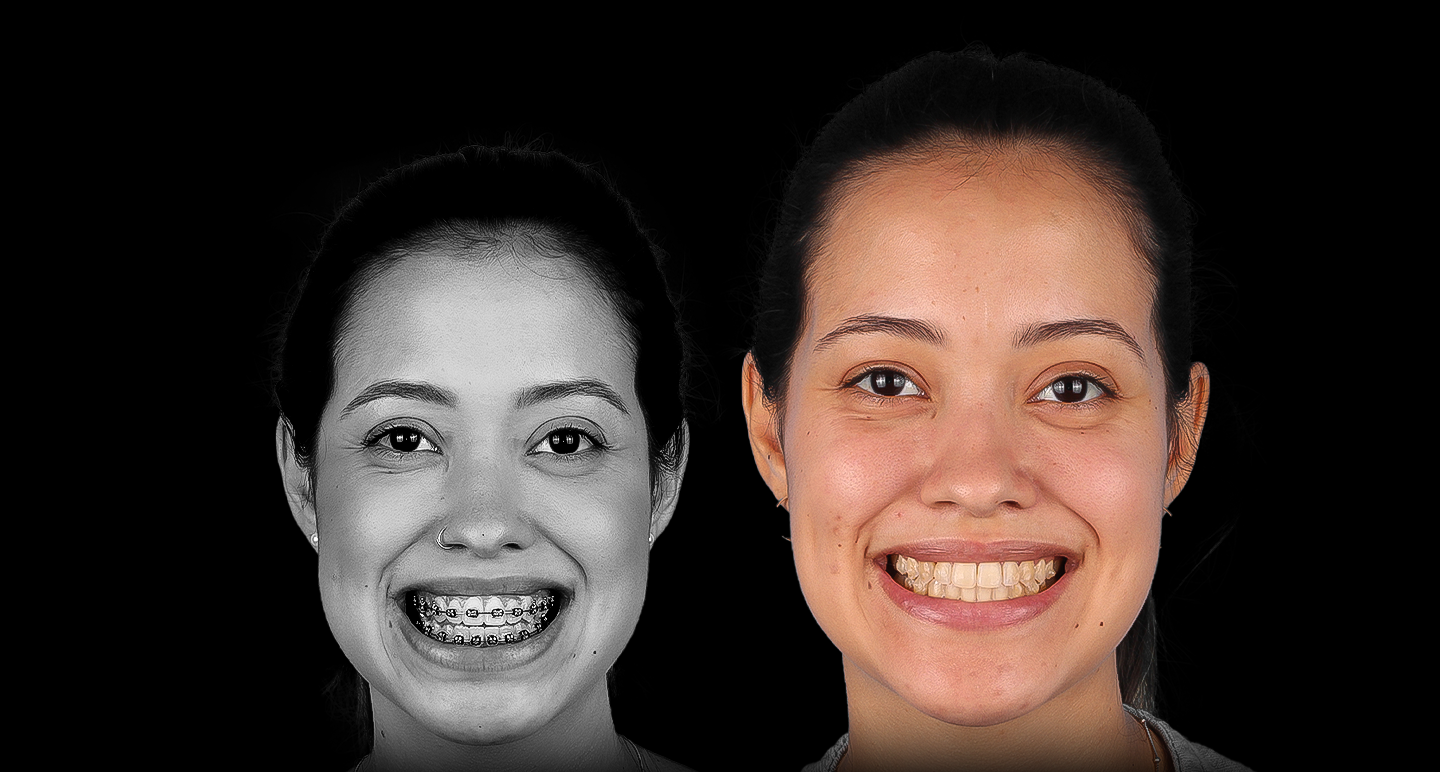 Antes e depois - Caso clínico 4