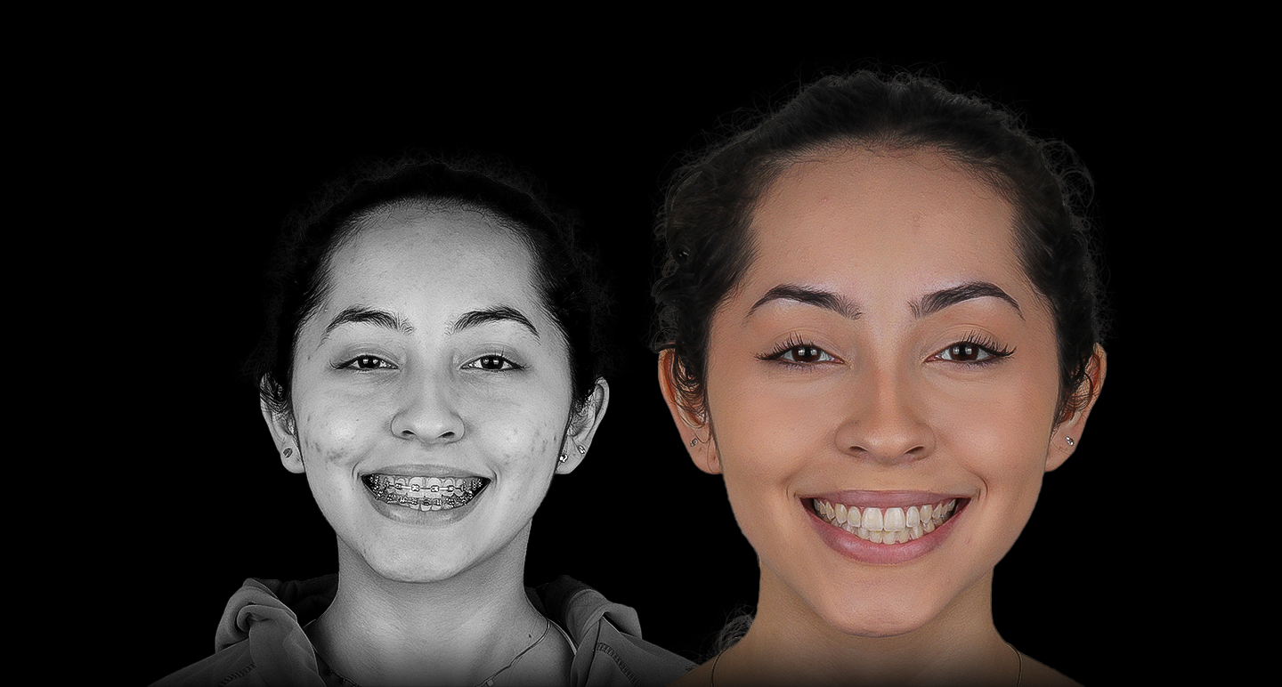 Antes e depois - Caso clínico 10