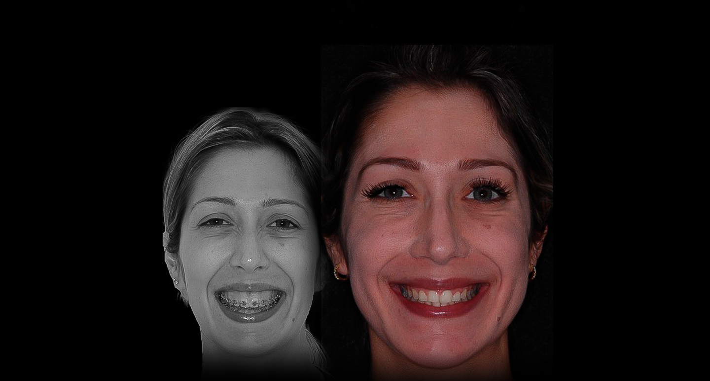 Antes e depois - Caso clínico 11