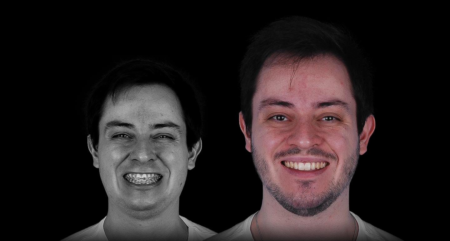 Antes e depois - Caso clínico 12