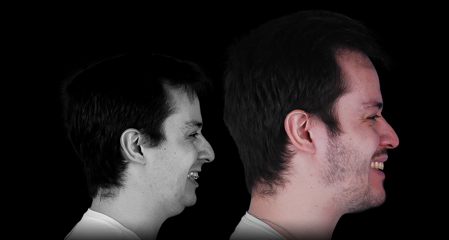 Antes e depois - Caso clínico 13