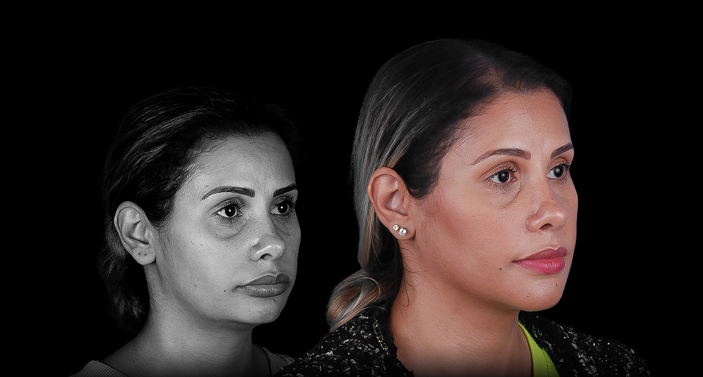 Antes e depois - Caso clínico 14