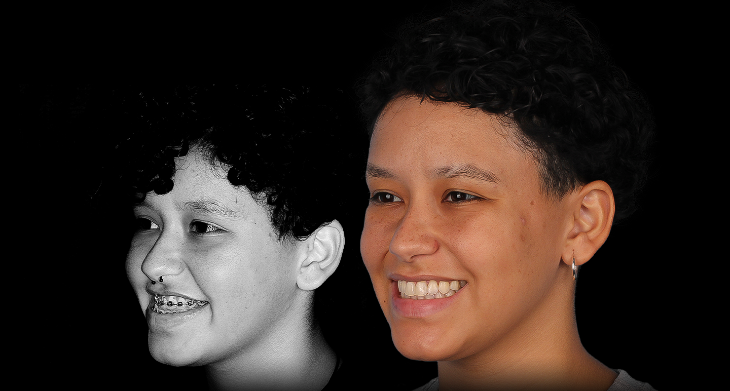 Antes e depois - Caso clínico 17