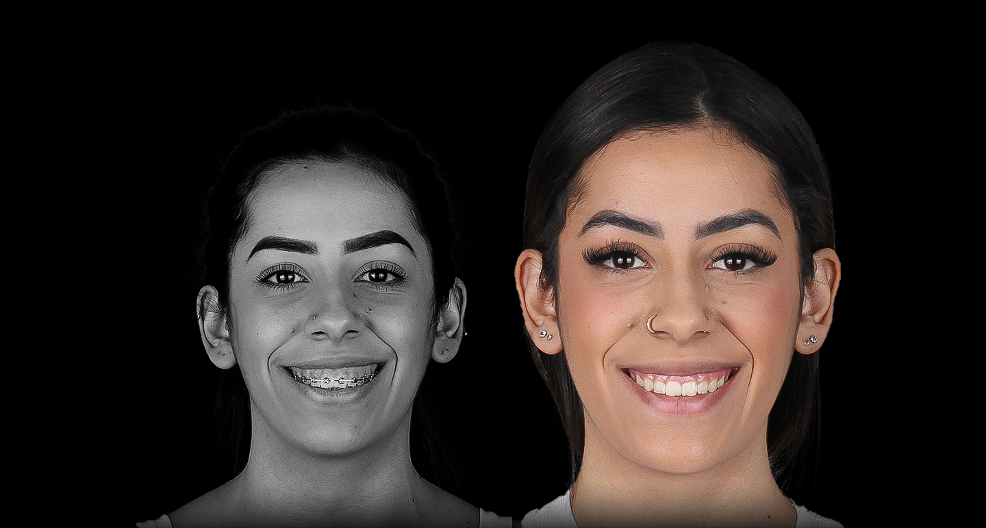 Antes e depois - Caso clínico 15