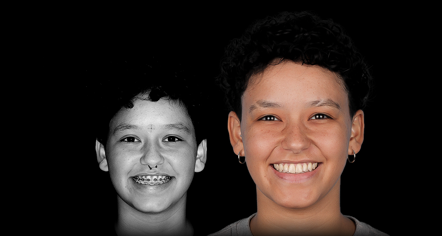 Antes e depois - Caso clínico 16