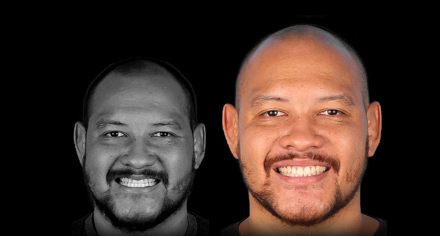 Antes e depois - Caso clínico 18