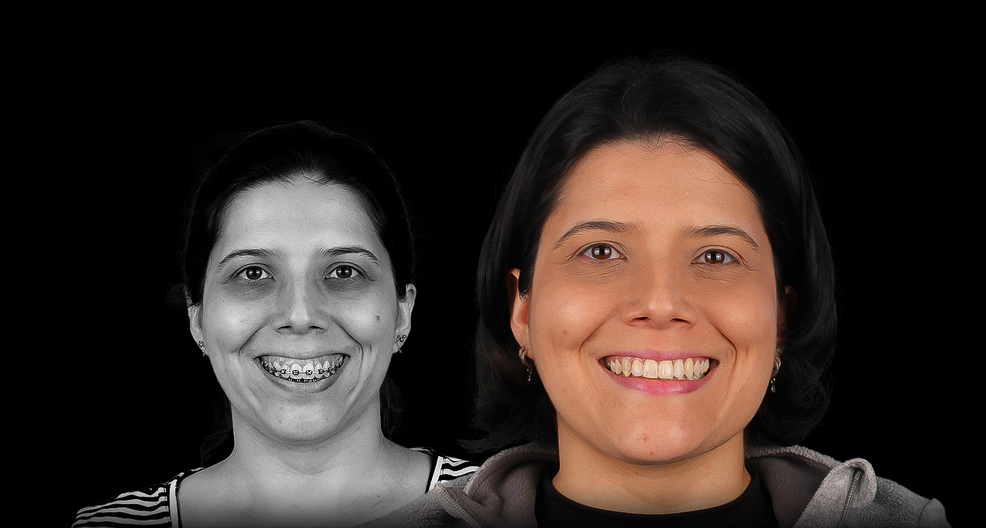 Antes e depois - Caso clínico 19